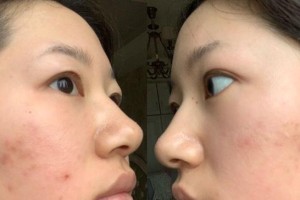 祛痘秘诀揭晓——以PALR为核心的护肤方法（拜拜痘痘，绽放自信！）